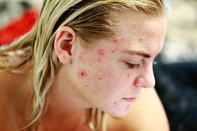 Blonde girl with acne on face